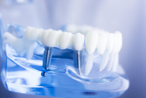 Is a Dental Bridge Permanent implant Is a Dental Bridge Permanent implant