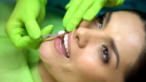 Veneers for Overbite application Veneers for Overbite application