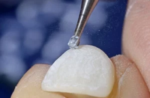 What Is Dental Veneers Before and After prep What Is Dental Veneers Before and After prep