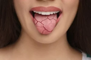 Does Plaque Cause Bad Breath dry Does Plaque Cause Bad Breath dry