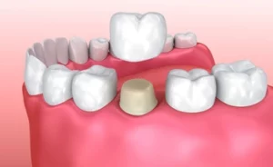 How Much Tooth Is Needed for a Crown procedure How Much Tooth Is Needed for a Crown procedure